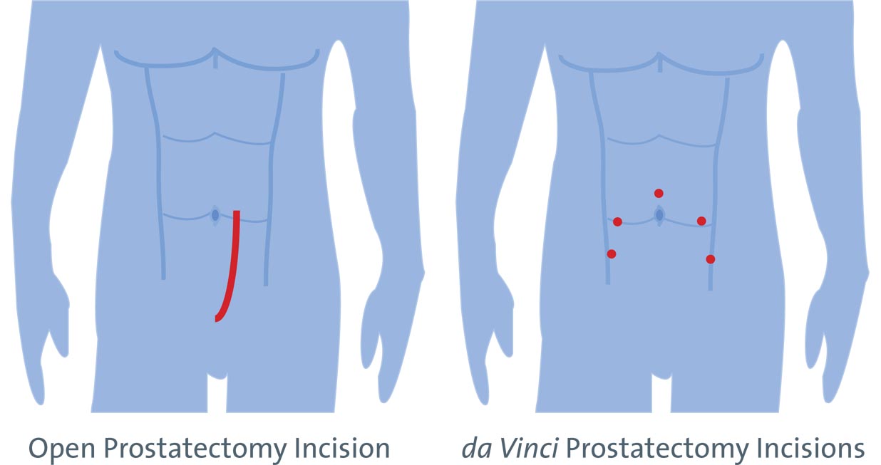 prostate incision comparison