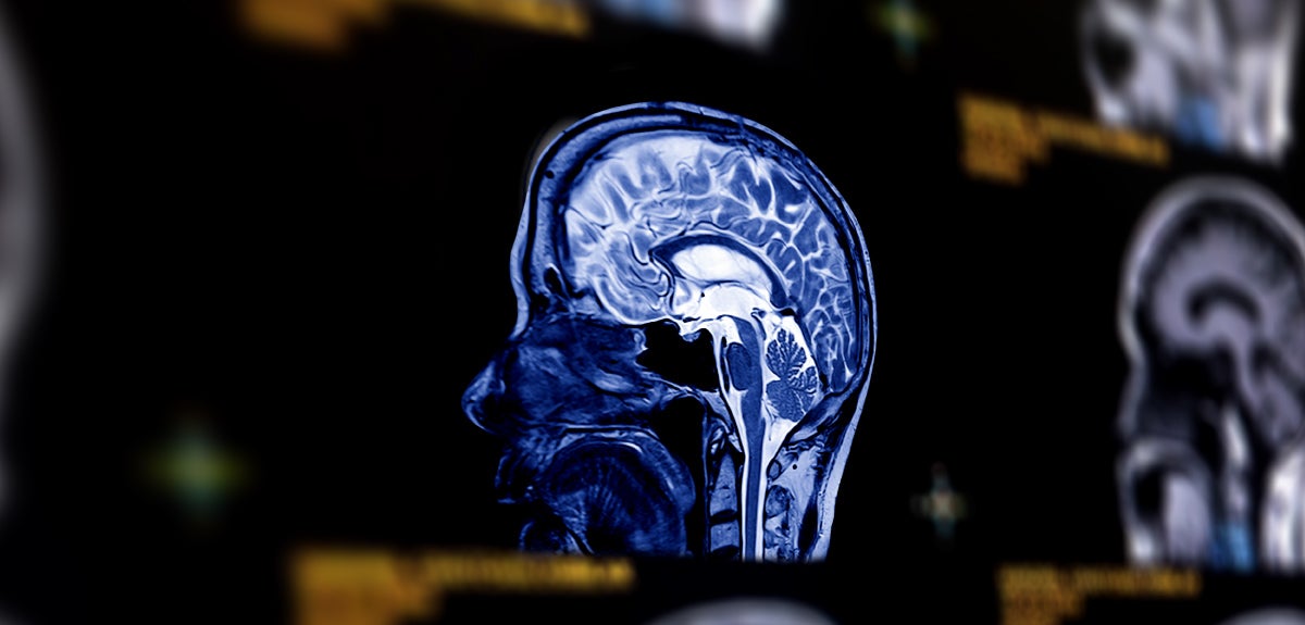 stroke signs