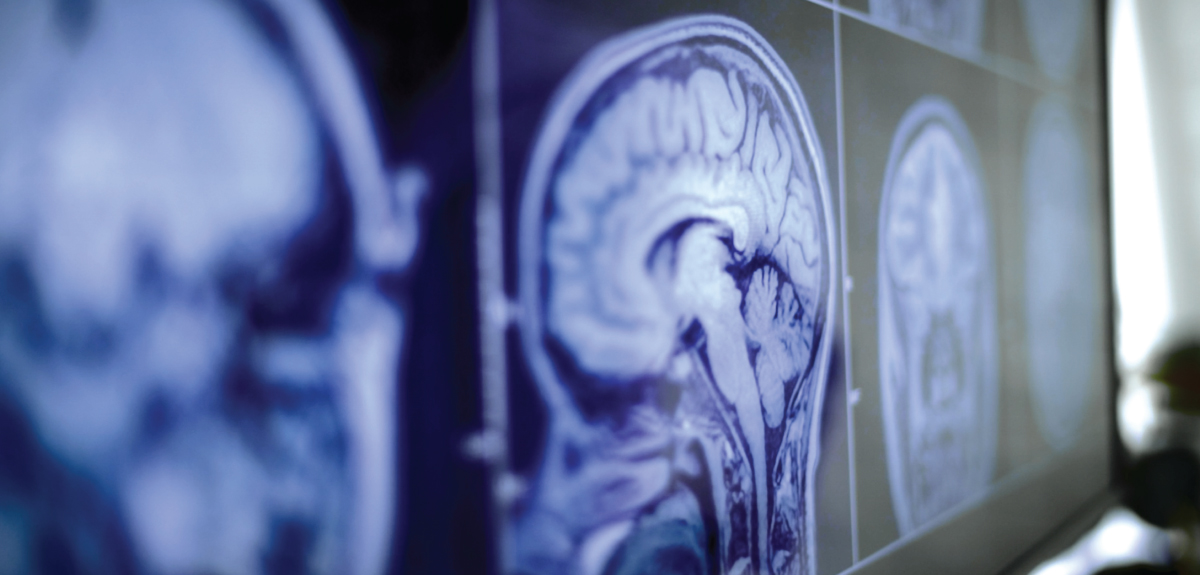 Stroke scan