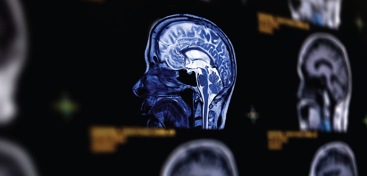 Stroke scan