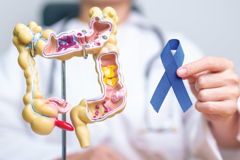 Colon cancer