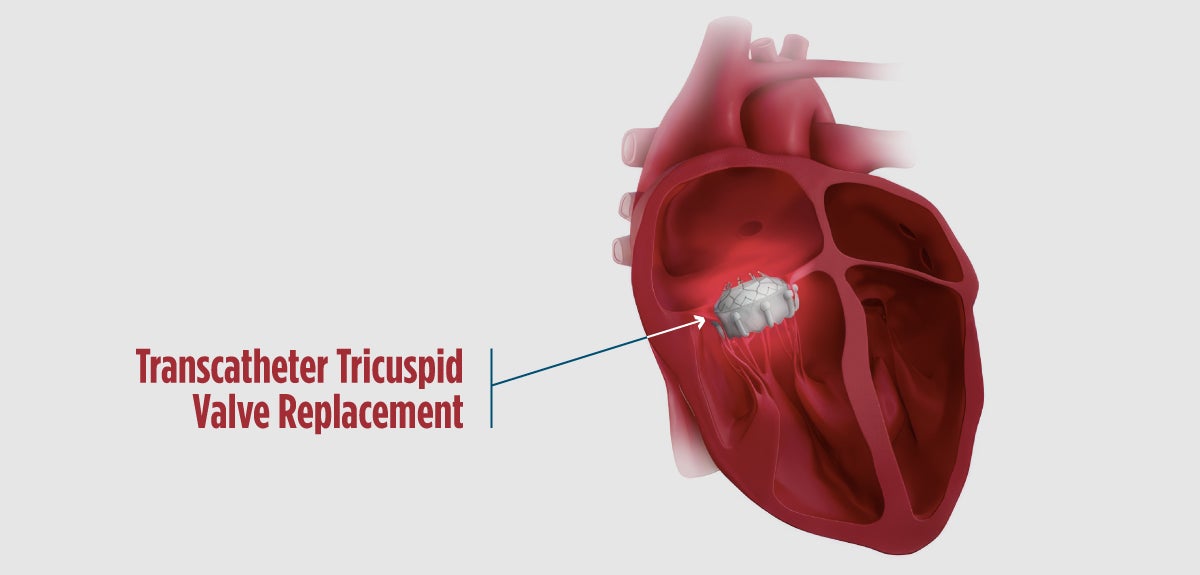 Trasncatheter Tricuspid Valve Repair